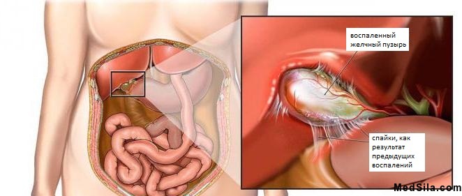 Картина обострения хронического некалькулезного холецистита