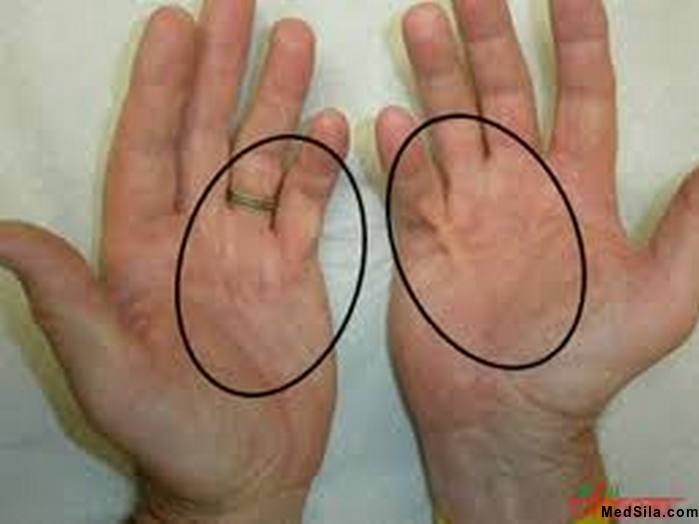 контрактура Дипюитрена